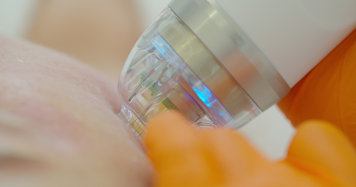 Close-up. Microneedle RF Lifting Procedure. Hardware Cosmetology. Beautician Conducts a Facial Rejuvenation Procedure for a Woman.